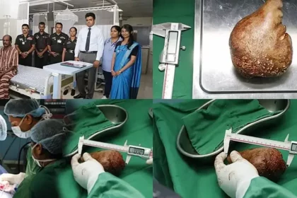 kidney stone